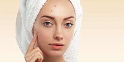 Woman pointing to zits on her face
