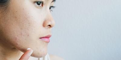 Woman with acne on her face applying cream to her chin